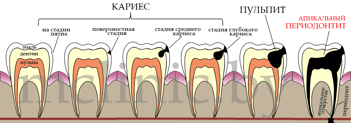 Стадии развития периодонтита на зубе