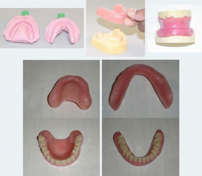 основные этапы изготовления полного зубного протеза