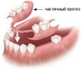 частично-съемный зубной протез