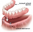 условно-съемный зубной протез