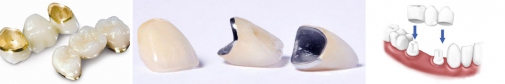 зубные протезы на основе металлокерамики