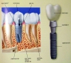 зубной имплантант и его составные части