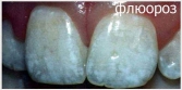 фотография зубов с флюорозом
