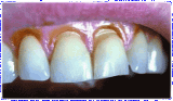 клиновидный дефект - осложнение из-за неправильной чистки зубов