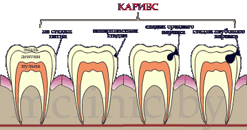 стадии развития кариеса на зубе