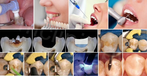 общий принцип лечения зубов, пораженных кариесом