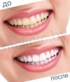 отбеливание зубов: до и после процедуры отбеливания